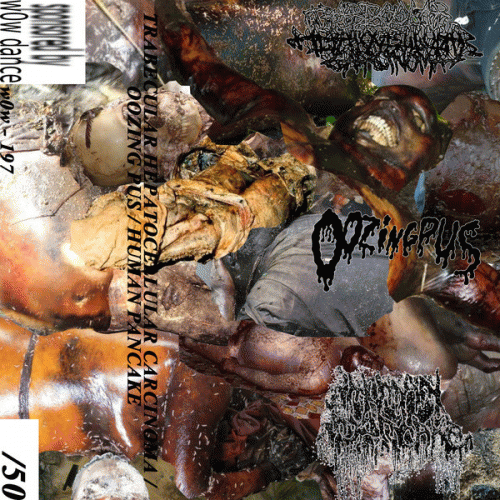 Trabecular Hepatocellular Carcinoma : Trabecular Hepatocellular Carcinoma - Oozing Pus - Human Pancake